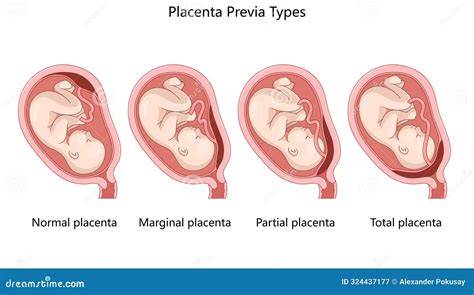 schema_plasenta_sarcina_multipla.jpg