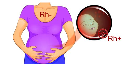 Schema incompatibilității Rh între mamă și făt