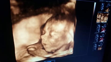 Ecografie 4D a unui făt de 20 de săptămâni