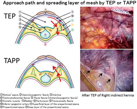 Schema(TAPP/TEP) reparare hernie ombilicala