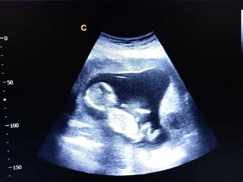 ecografie făt 8 săptămâni