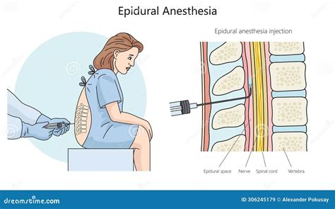 Schema anesteziei epidurale