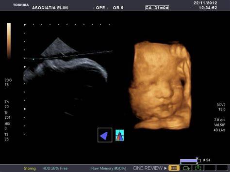 ecografie morfologie fetala - imagine aparat ecograf si monitor cu fat