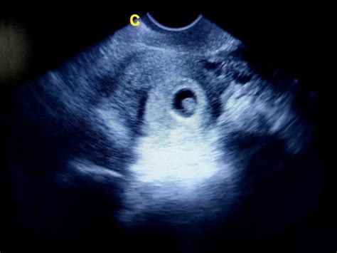 ecografie embrion săptămâna 5