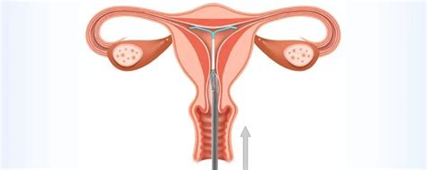 Forma steriletului T