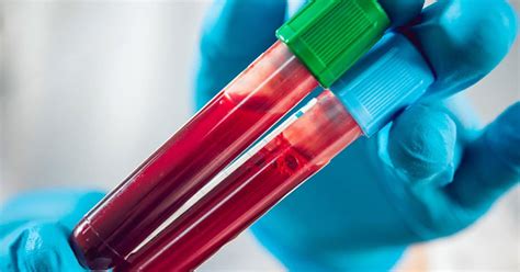 Test de laborator pentru analiza de sânge hCG