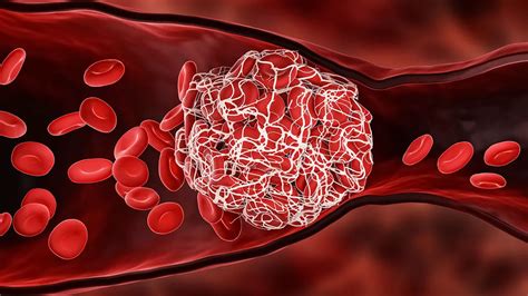 Ilustrație schematică a formării unui cheag de sânge