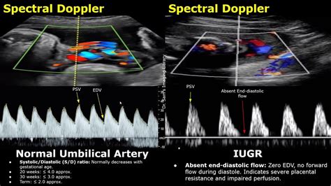 Grafic: artera ombilicală Doppler RI vs. sarcini normale și IUGR