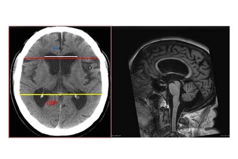 Diagramă: fluxul normal al lichidului cefalorahidian vs. hidrocefalie