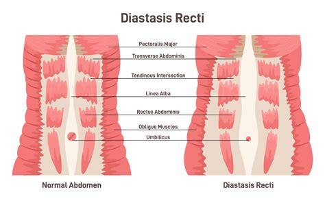 Infografic: modificări ale abdomenului în sarcină, diastasis recti, și poziții de exerciții sigure