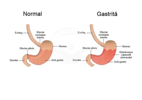 Diag endoscopic gastrita - imagine ilustrativa