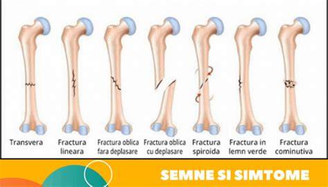 Infografie: Anatomia claviculei și tipuri de fracturi