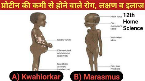 Clasificare MPC: marasm, kwashiorkor și forme hibride