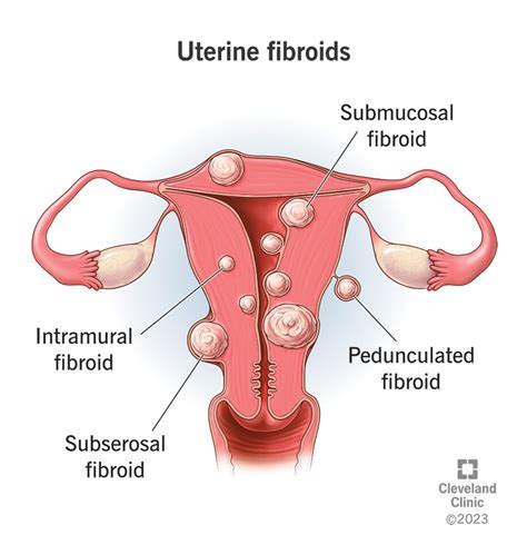 Diagrama anatomiei uterine cu fibrom