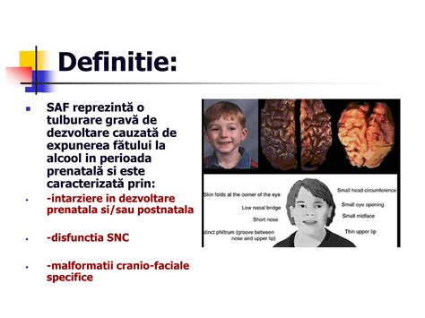 Trasaturi faciale specifice sindromului alcoolismului fetal