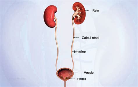 Imagine reprezentând un calcul renal