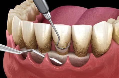 Imagine: Schema comparativă chiuretaj gingival vs. subgingival vs. parodontal