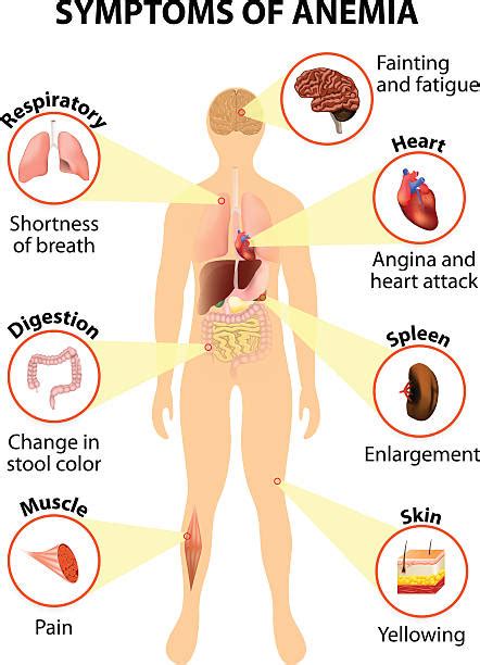 Infografic cu simptomele anemiei