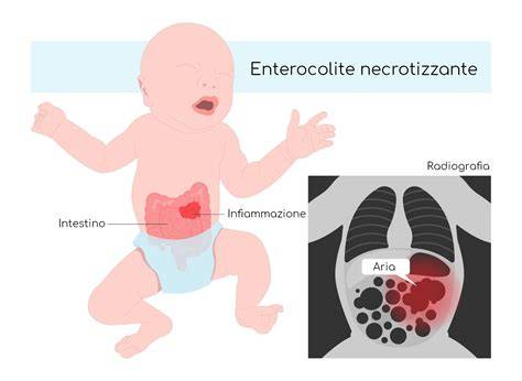 Schema managementului enterocolitei necrozante la nou-născuți