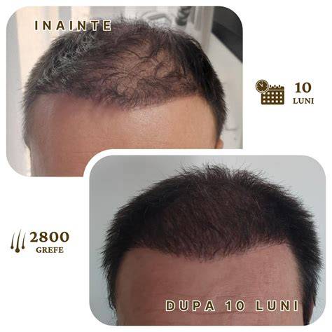 Cronologie tratamente estetice: epilare, transplant sprâncene, implant păr