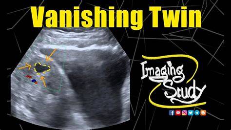 Diagrame: vanishing twin si corionicitate