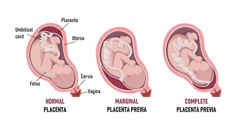 Diagramă care ilustrează placenta previa și placenta normală