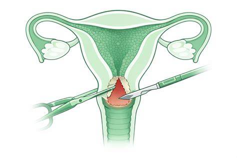 Infografic ERAD: cum se realizează excizia leziunii cervicale