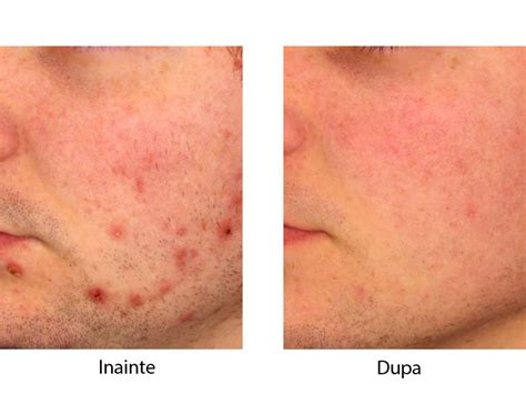 Tabel comparativ: Roaccutane vs. alte tratamente pentru acnee