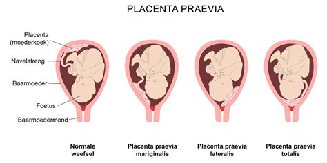 Ilustrație cu placenta praevia