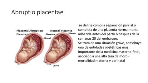 Diagrama abruptio placentare