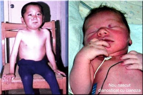 Nou-nascut cu cianoza