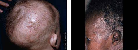 diagnoza-dermatologica-scalp-bebelus