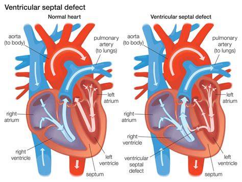 Infografic: fluxul sangvin normal vs. defect septal ventricular