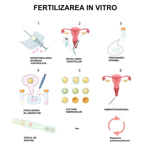 Infografic: etapele FIV ( stimulare, prelevare, fertilizare, embrion transfer, crioprezervare)