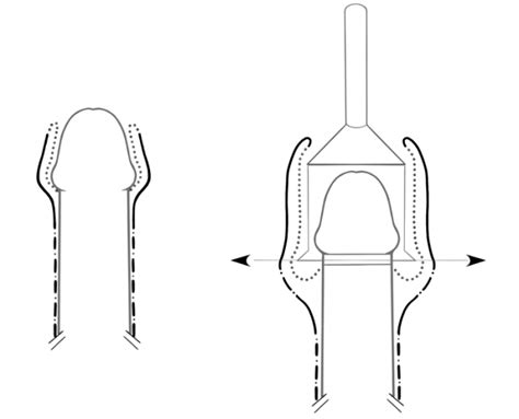 Opțiuni de tratament pentru fimoza