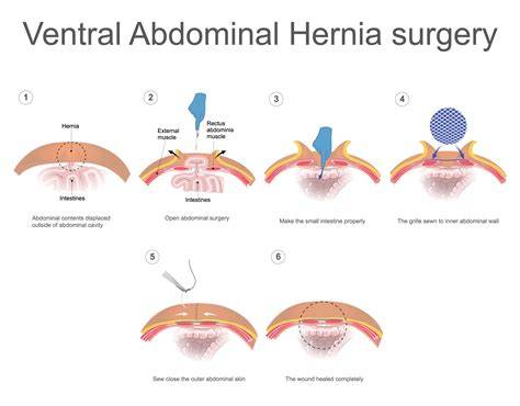 Hernioplastie vs. Herniorafie: ilustrație a tehnicilor chirurgicale