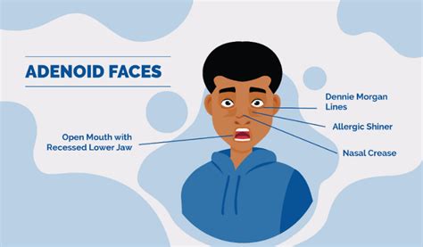 Ilustrație a trăsăturilor faciale caracteristice faciesului adenoid