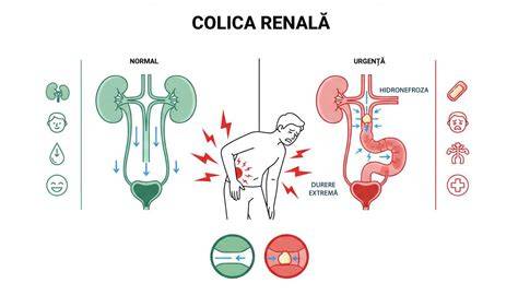 Infografie: diferente intre colica biliara, colica renala si colici digestive la adulti