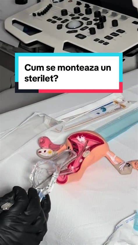 schemă: cum se montează un sterilet