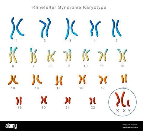 cariotip_sindroame_Klinefelter_Turner