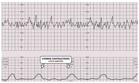 Frecvența cardiacă fetală normală în timpul sarcinii