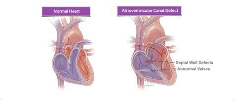 Imagine schemă a canalului atrioventricular comun: structură normală vs AVSD