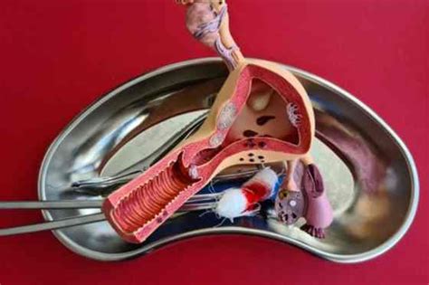 Schema cu tipurile de epiziotomie