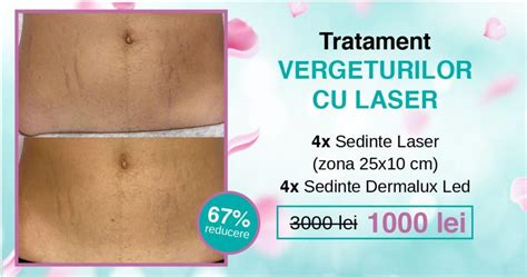 Pielea în timpul sarcinii: vergeturi și hiperpigmentare