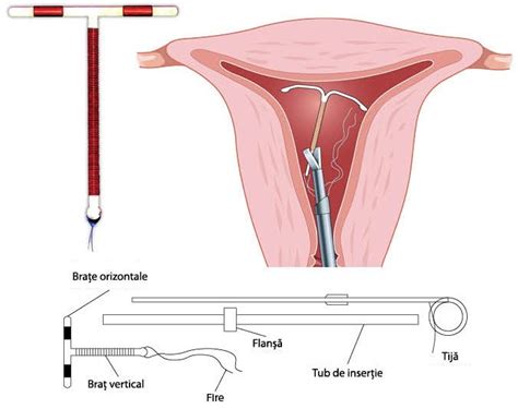 Diagrama unui sterilet în formă de T