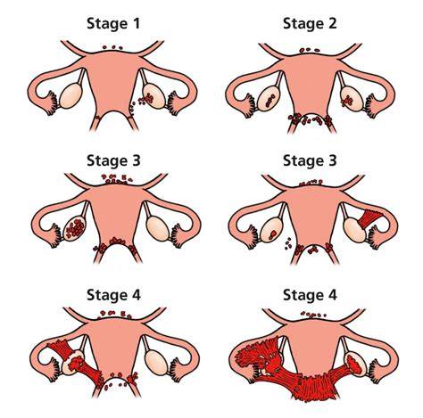 Diagrame: endometrioza in pelvis vs. lichidări inflamatorii