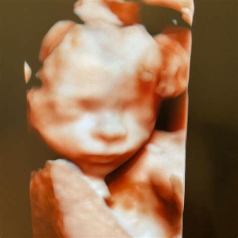 ecografie morfologie fetala