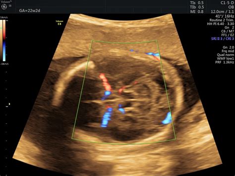 schema ecografie morfologica fetala