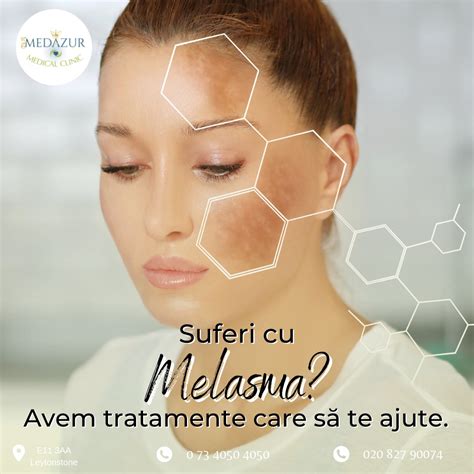 Fată cu pete de melasmă