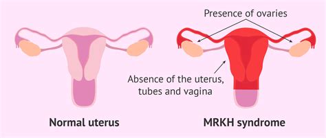 Infographic: Clasificare MRKH tip I vs tip II cu trăsături asociate